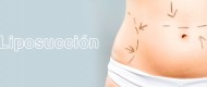 liposuccion